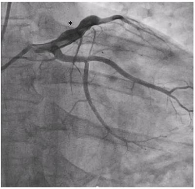Hematopoietic Stem Cell Transplantation and Vasculopathy Associated With STAT3-Dominant-Negative Hyper-IgE Syndrome